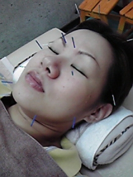 坂本はり灸治療院 美容鍼のメニュー画像