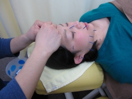 篠崎つばさ整骨院・鍼灸院  美容鍼のメニュー画像