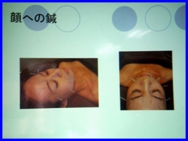 健康堂施術所 美容鍼灸コースのメニュー画像