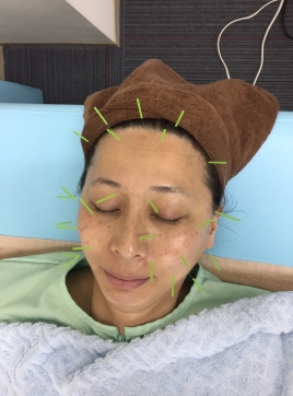 ハロー鍼灸治療院 美容鍼のメニュー画像