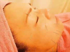岩島治療院 オーダーメイド美容鍼のメニュー画像