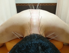 北京堂鍼灸　イワサキ 首、背中のコリ、痛みのメニュー画像