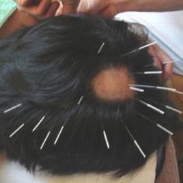 千里堂調布鍼灸治療院 脱毛症のための鍼灸治療のメニュー画像