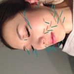 摂津正雀鍼灸整骨院 美容鍼灸のメニュー画像