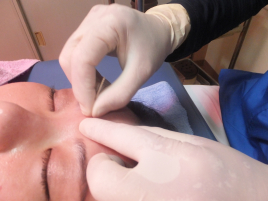 鍼灸院シーワン  美容美顔鍼のメニュー画像