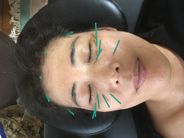 鍼灸治療院 新氣堂 美肌美容鍼+鍼灸コースのメニュー画像