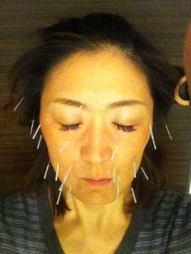 成田東ほがらか鍼灸院 美顔鍼フェイシャルのメニュー画像