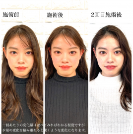IKEZAKI鍼灸院 美容鍼+小顔矯正のメニュー画像