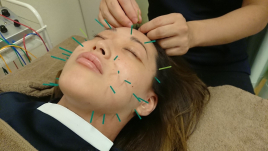 ヴェルデ鍼灸院 美容鍼コースのメニュー画像