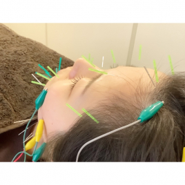 himawari鍼灸院 クイック美容鍼のメニュー画像