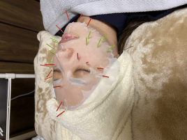 ささき鍼灸院 フェイスパック美容鍼のメニュー画像