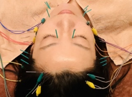 シャルム  美容鍼灸 立体造顔電流美容鍼　「お顔のみ」のメニュー画像