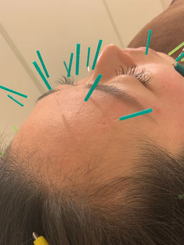 himawari鍼灸院 眼精疲労の鍼灸のメニュー画像