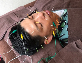 retreat鍼灸院 【男性】リフトアップ美容鍼40分のメニュー画像
