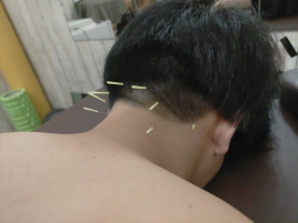鍼灸サロンSolare 首肩集中ケアのメニュー画像