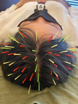 Acupuncture salon LINOA リノア鍼灸院 美髪鍼のメニュー画像