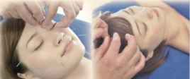 レモンキュア平塚治療院 美容鍼コース＋頭皮鍼コースのメニュー画像