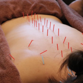 美容鍼専門サロン　Ocean 【初回限定】身体の治療鍼のメニュー画像