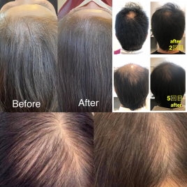 鹿児島美容鍼灸サロンCalla（カラー） 頭皮ナノ美容鍼灸のメニュー画像