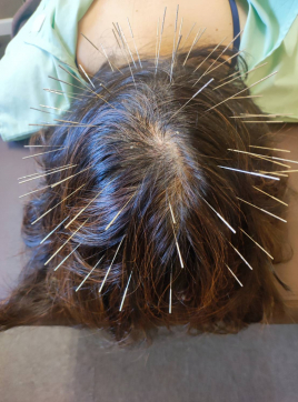 鍼処SANRI～ルート治療専門院～ 育毛鍼灸（ルート治療）30分ショートのメニュー画像