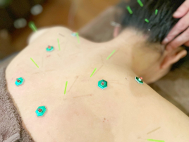 HARINIQ銀座 美容鍼＆鍼灸治療のメニュー画像