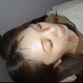 アリス鍼灸整骨院 美容鍼（健康治療コース）のメニュー画像