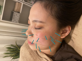 美容鍼灸サロンReturel-リチュアル- スキンケア美容鍼のメニュー画像