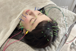 美容鍼灸整体 HARIKA 東京 新宿店 頭皮鍼(頭とこめかみの鍼電気)のメニュー画像