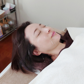 鍼灸院 バーディー 【オプション】プラス美容鍼灸のメニュー画像