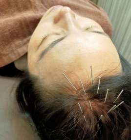 IBISOU鍼灸所沢 ３０代お勧め「育毛鍼×美容鍼×エステ」のメニュー画像