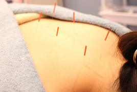 オリエントエクスプレス 鍼灸治療（肩こり、腰痛、疲労）のメニュー画像