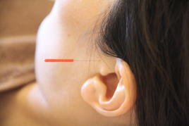 オリエントエクスプレス 鍼灸治療（突発性難聴・耳鳴・メニエール）のメニュー画像