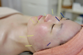 鍼灸サロンMinori　浜松店 美容鍼 クイックコース（女性スタッフ）のメニュー画像