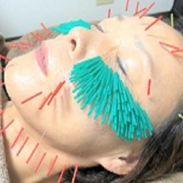 川口つばき鍼灸院 美容鍼灸コースのメニュー画像