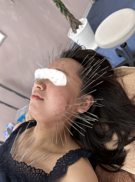 鍼灸サロンacus（アクス）ルート鍼治療専門 ルート鍼治療　鬼美容鍼のメニュー画像