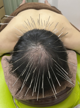 鍼灸サロンacus（アクス）ルート鍼治療専門 薄毛にルート鍼治療（30分）のメニュー画像