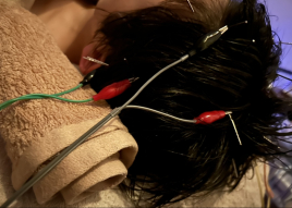 美容鍼灸サロン　sweet alyssum ヘッドスパ鍼のメニュー画像