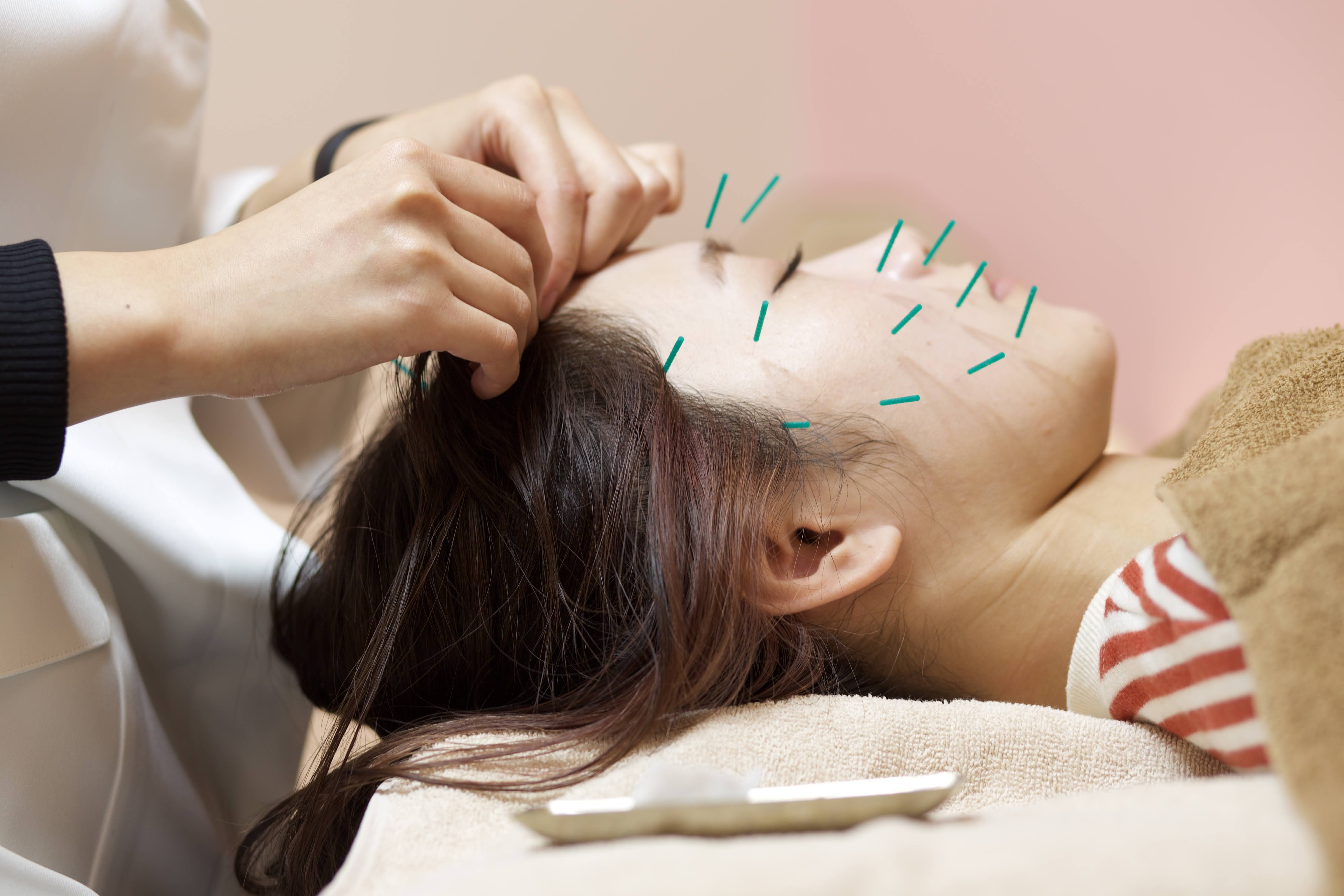 鍼灸サロンHariBear 【清家担当】⑥美容鍼のメニュー画像