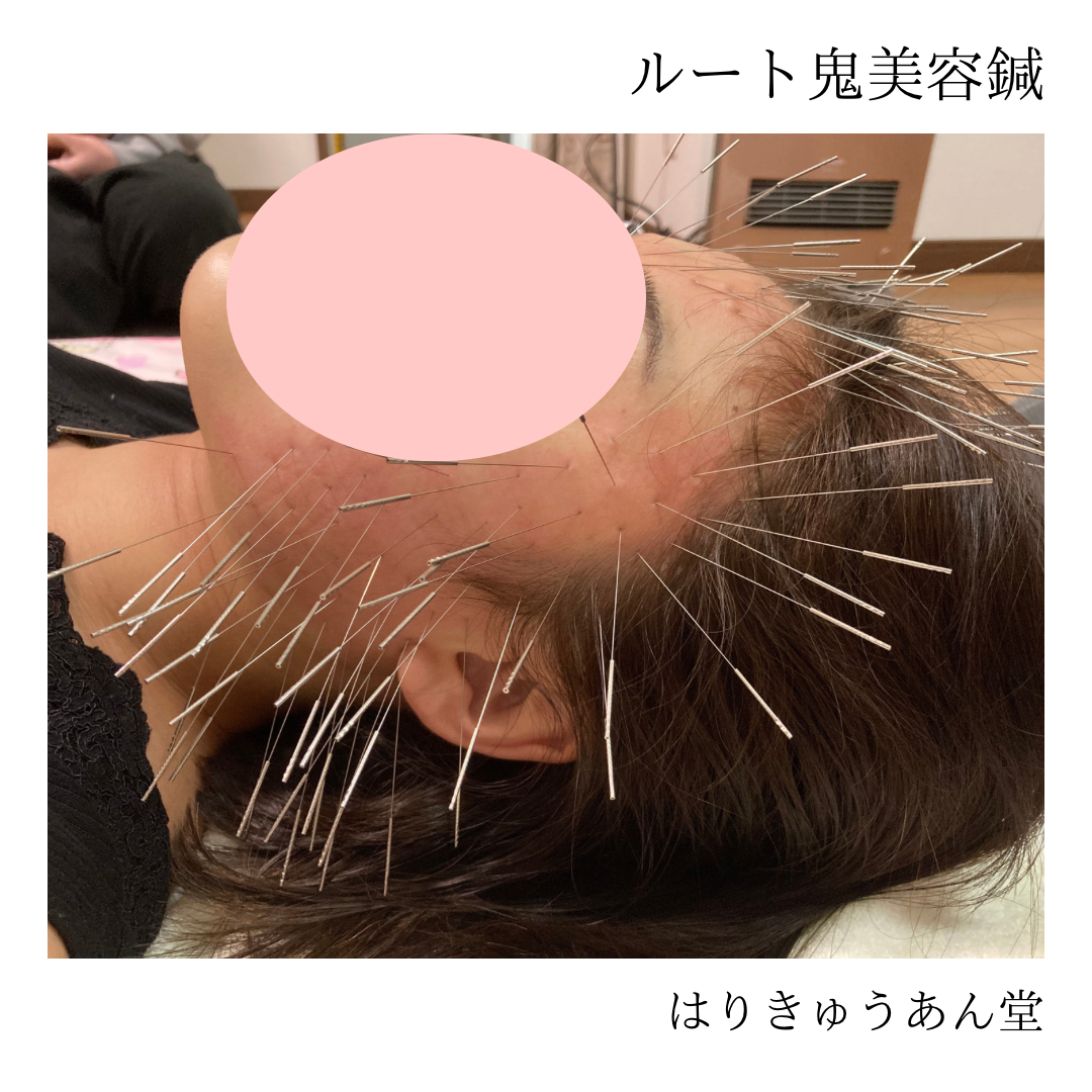 はりきゅうあん堂｜ルート治療 ルート鬼美容鍼60分コースのメニュー画像