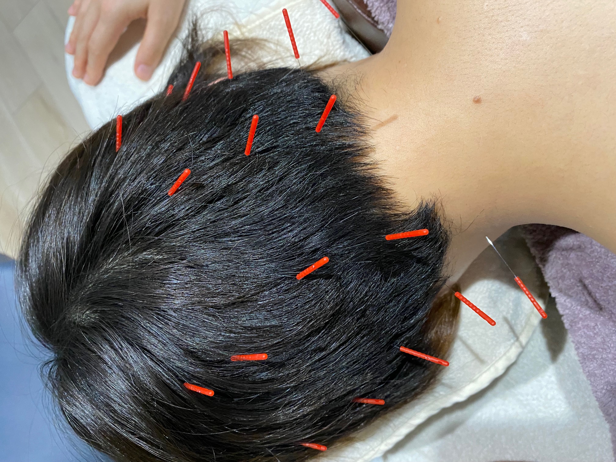 鍼灸サロン ハリシア 頭の鍼24本のメニュー画像
