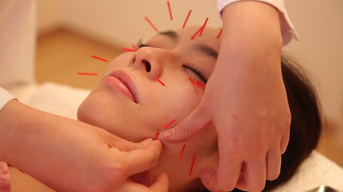 鍼灸サロン meilong 小顔電流+美鍼（10本まで）のメニュー画像