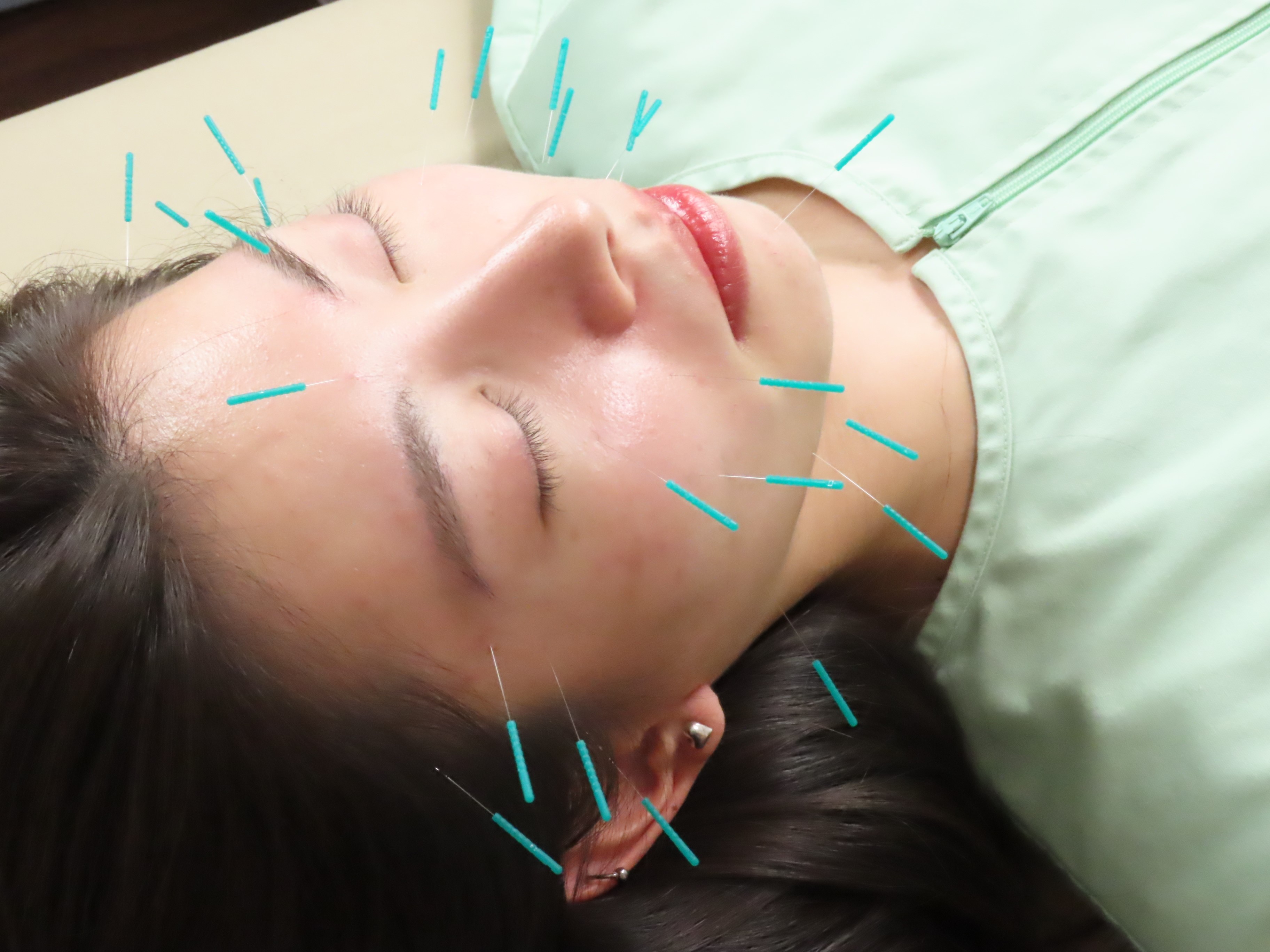 そらうみ鍼灸治療サロン 美容鍼コースのメニュー画像