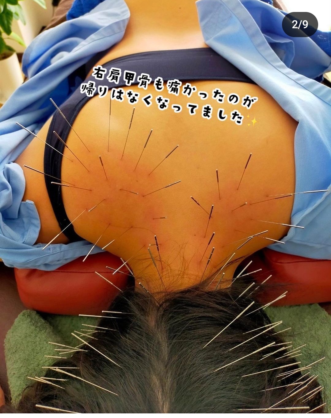 鍼処　卓－taku－  ルート治療専門院 ルート鍼治療　30分のメニュー画像