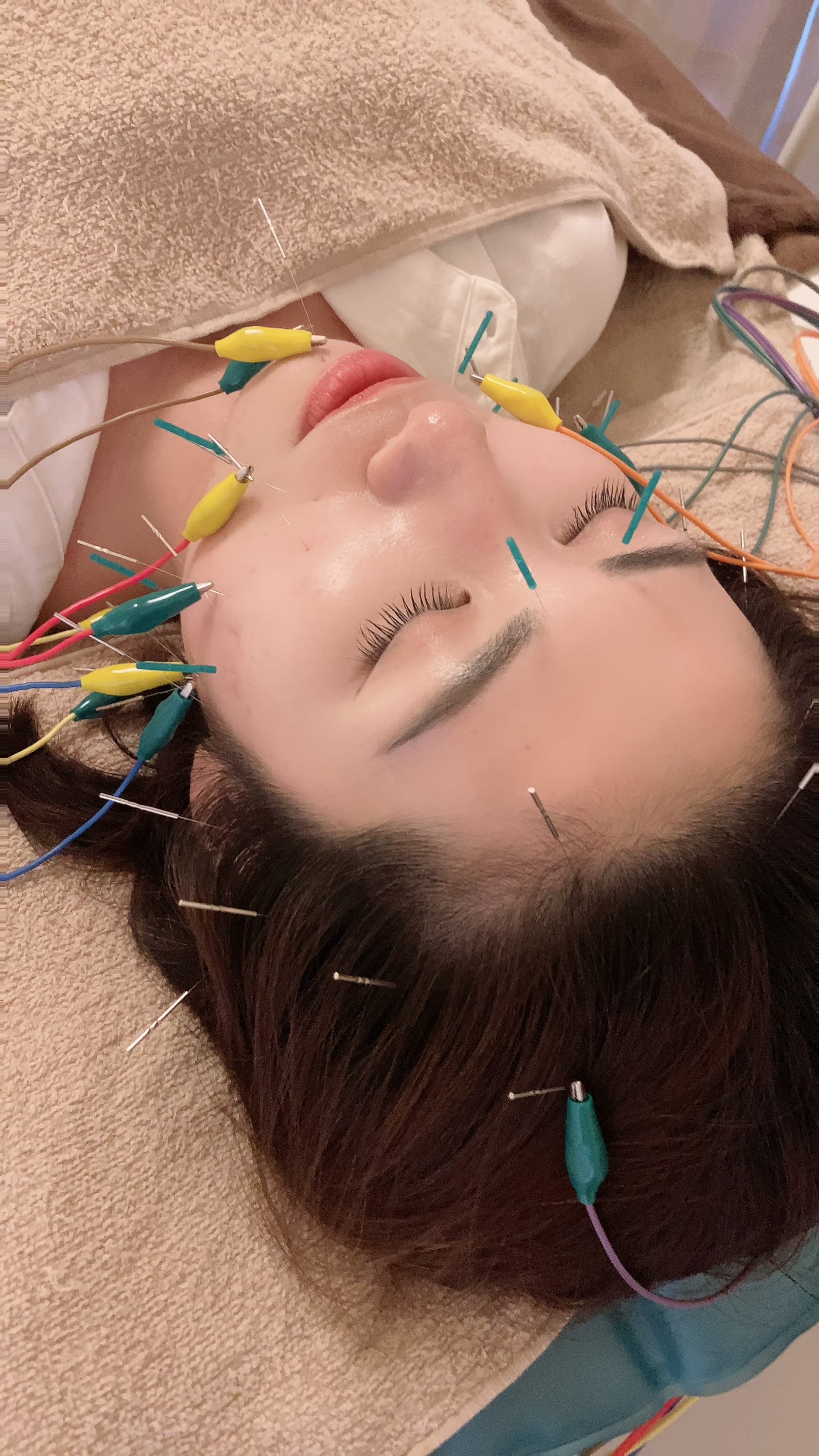 女性専用鍼灸サロン はりりん リフトアップ美顔鍼60分コースのメニュー画像