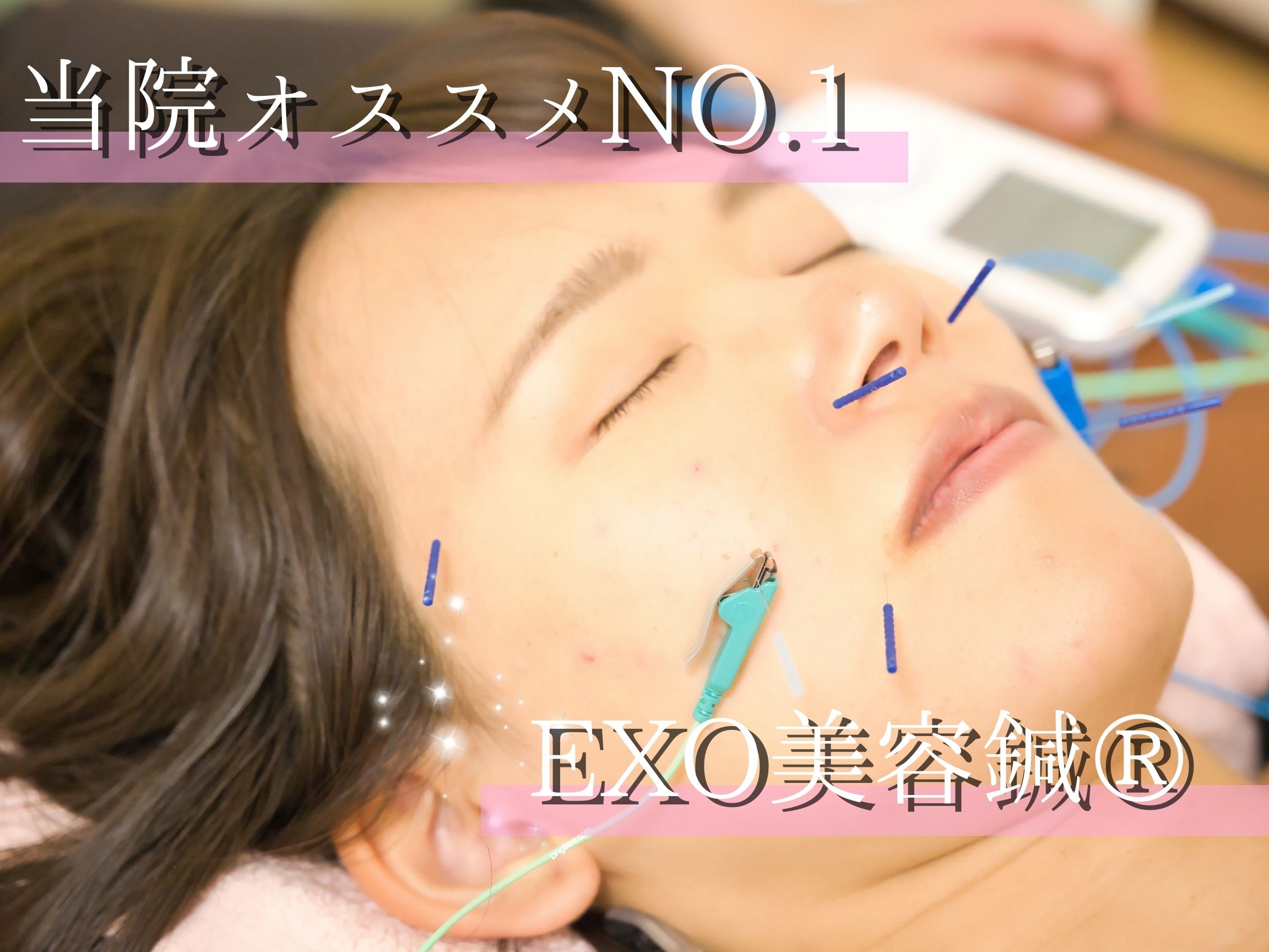 美容鍼灸サロンBellata 【初回お試し】EXO美容鍼Ⓡのメニュー画像