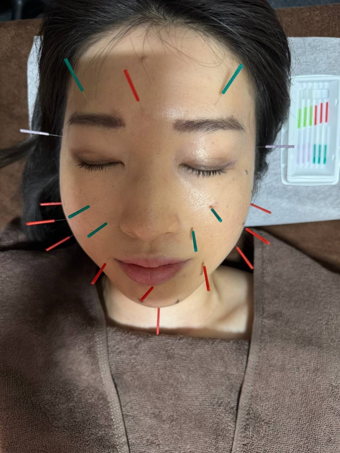KAKA鍼灸院 美顔鍼のメニュー画像